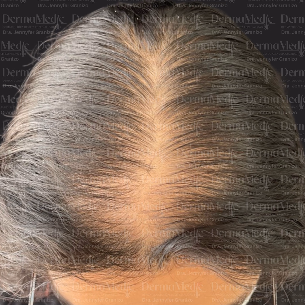 Alopecia · Trasplante capilar